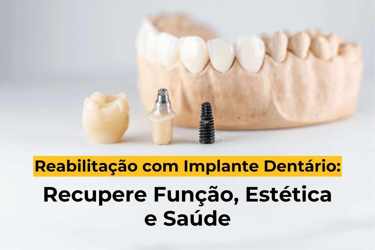 Reabilitação com Implante Dentário em Maringá: Recupere Função, Estética e Saúde