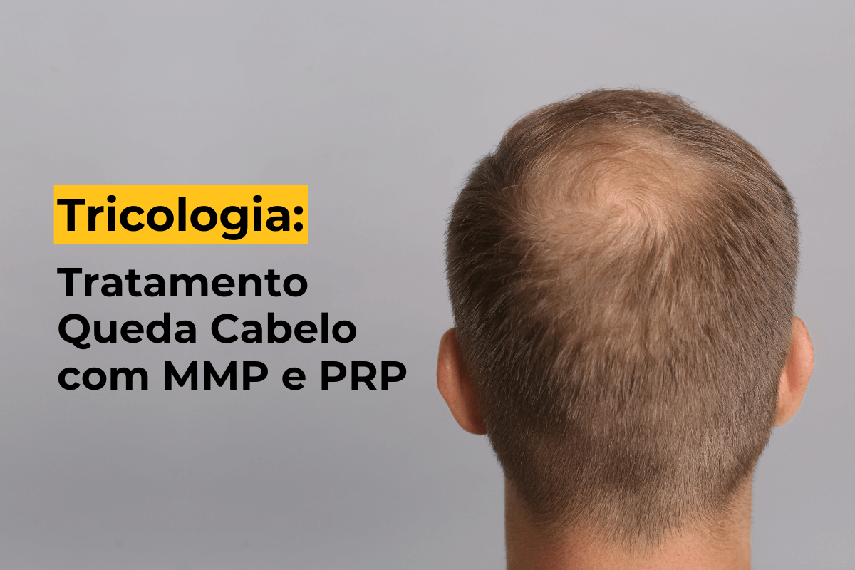 Tricologia em Maringá: Tratamento Queda Cabelo com MMP e PRP