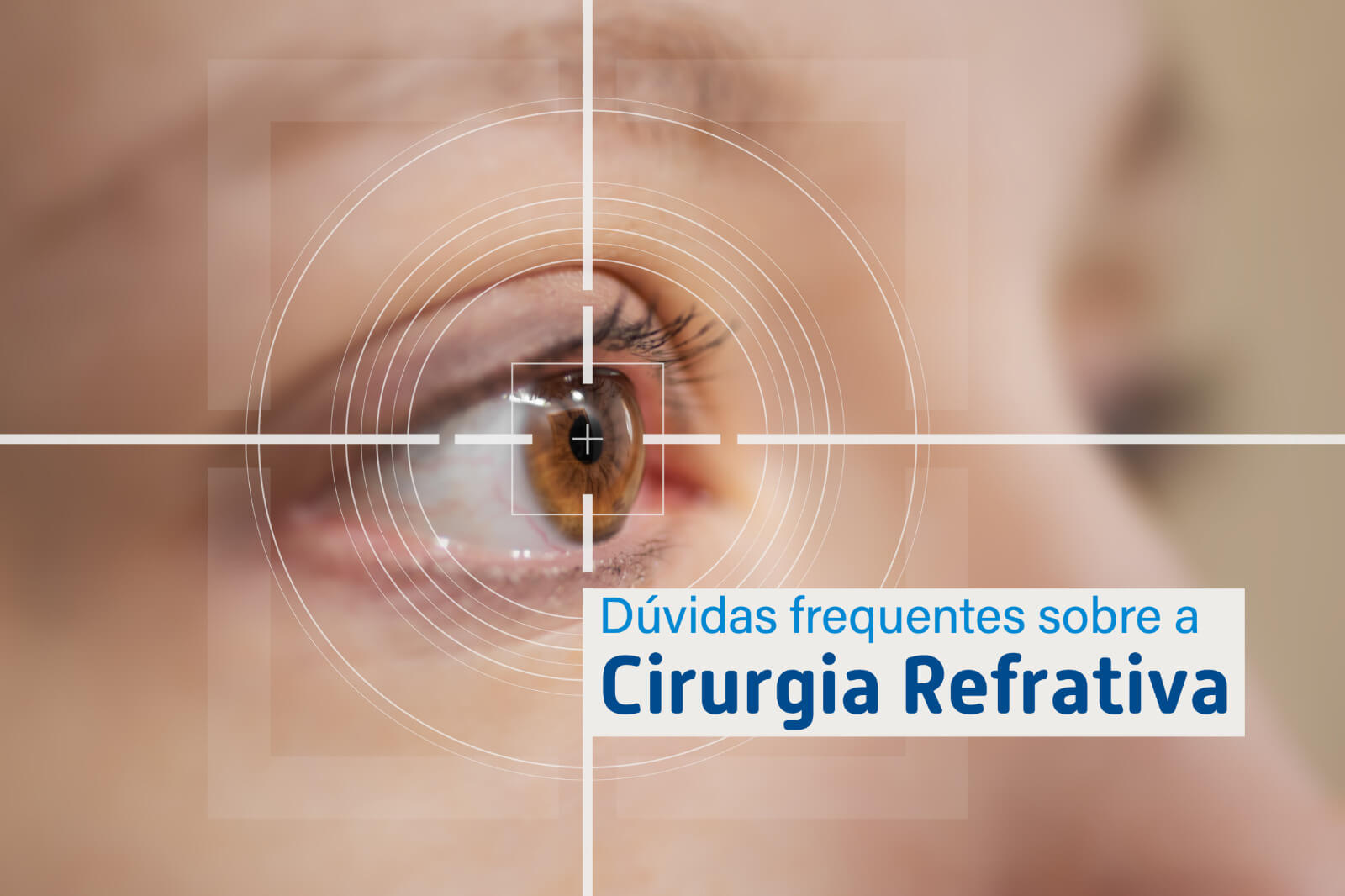 Dúvidas frequentes sobre a Cirurgia Refrativa