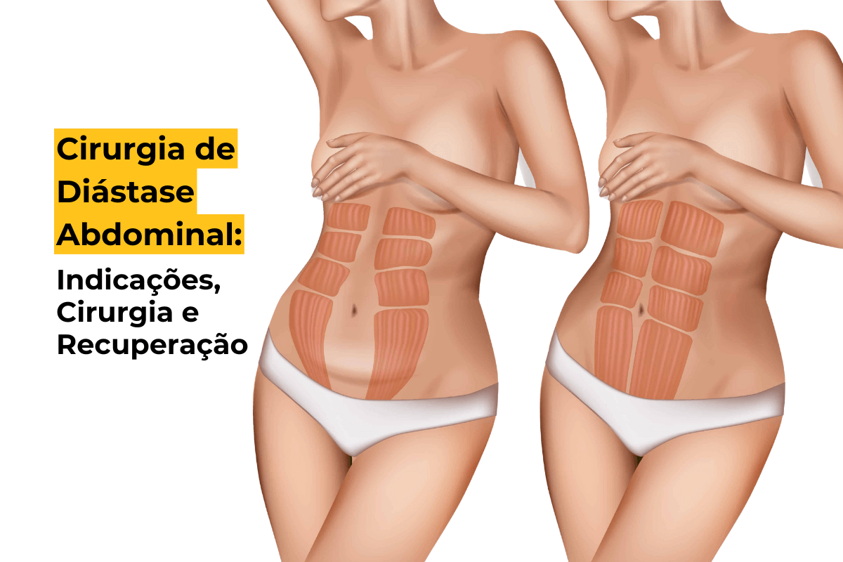 Cirurgia de Diástase Abdominal em Curitiba: Indicações, Cirurgia e Recuperação