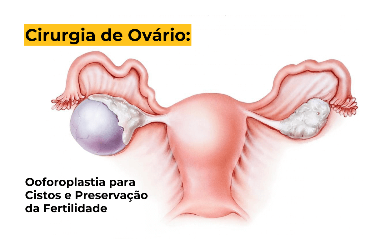 Cirurgia de Ovário em Maringá: Ooforoplastia para Cistos e Preservação da Fertilidade