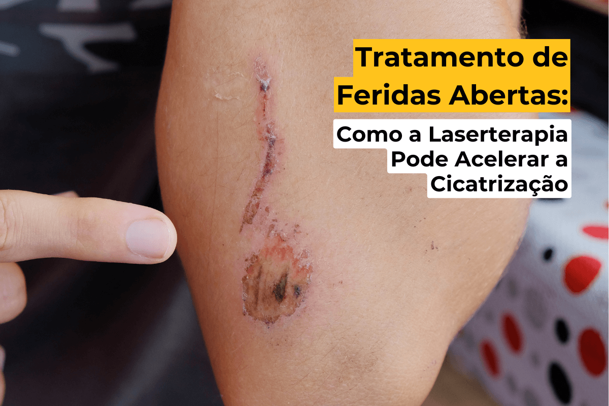 Tratamento de Feridas Abertas em Maringá: Como a Laserterapia Pode Acelerar a Cicatrização
