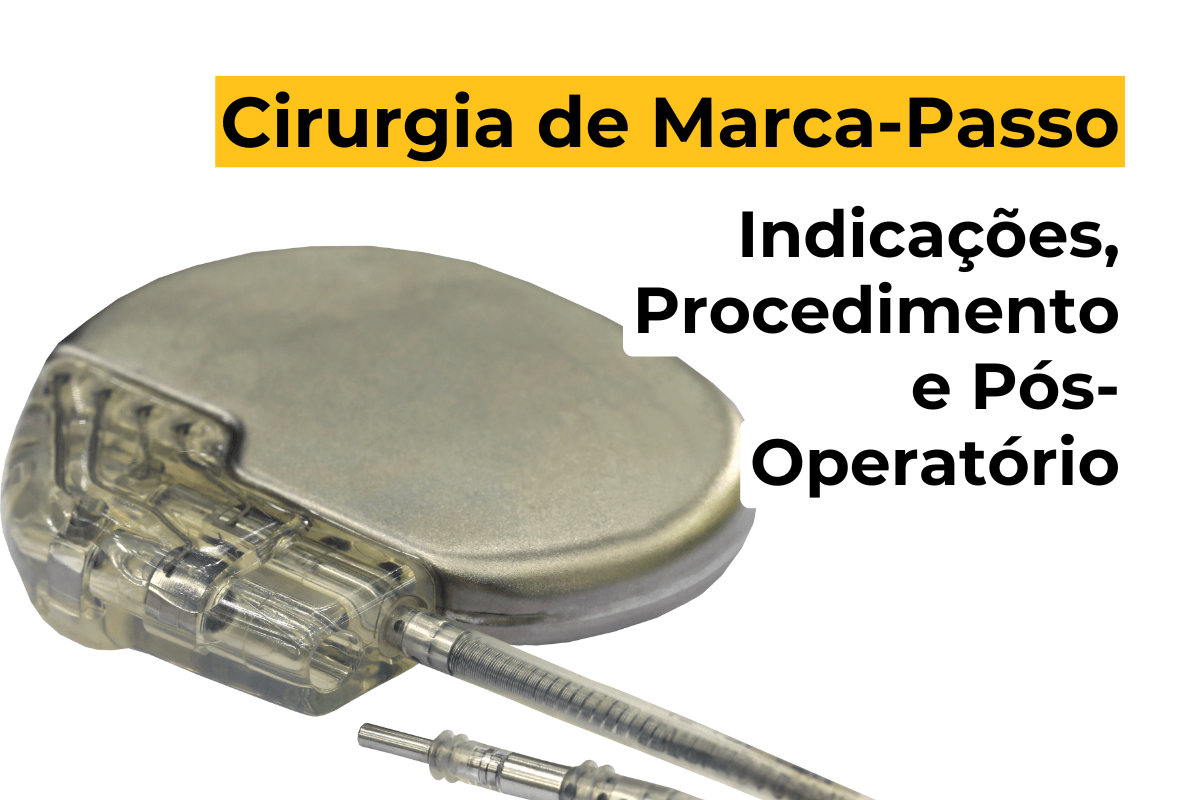 Cirurgia de Marca-Passo em Maringá: Indicações, Procedimento e Pós-Operatório
