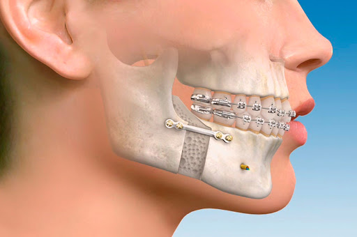 Cirurgia Ortognática  