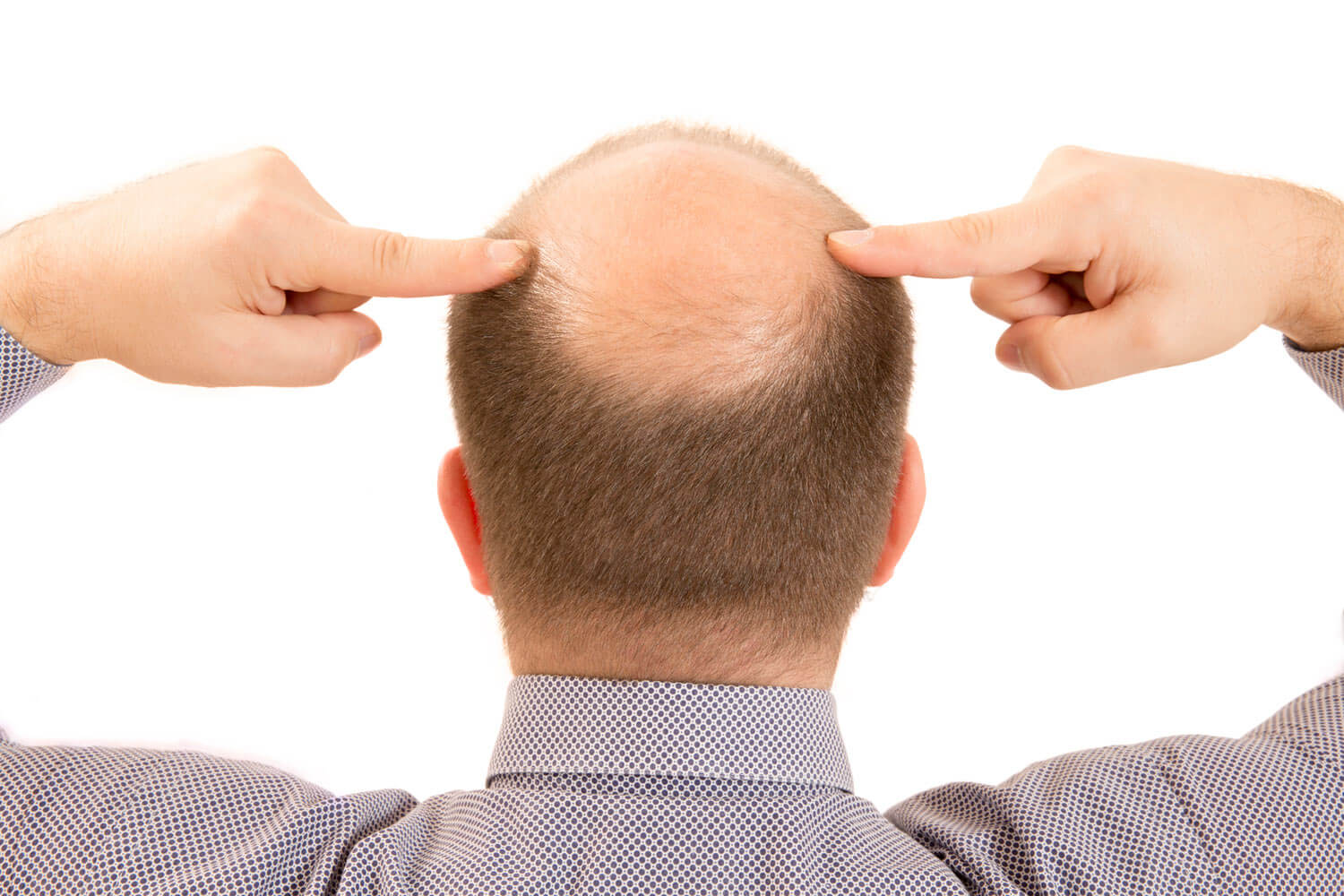 Calvície – Alopecia Androgenética