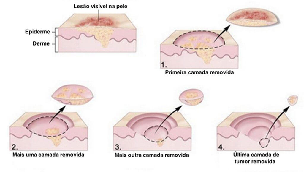 Cirurgia Micrográfica de MOHS