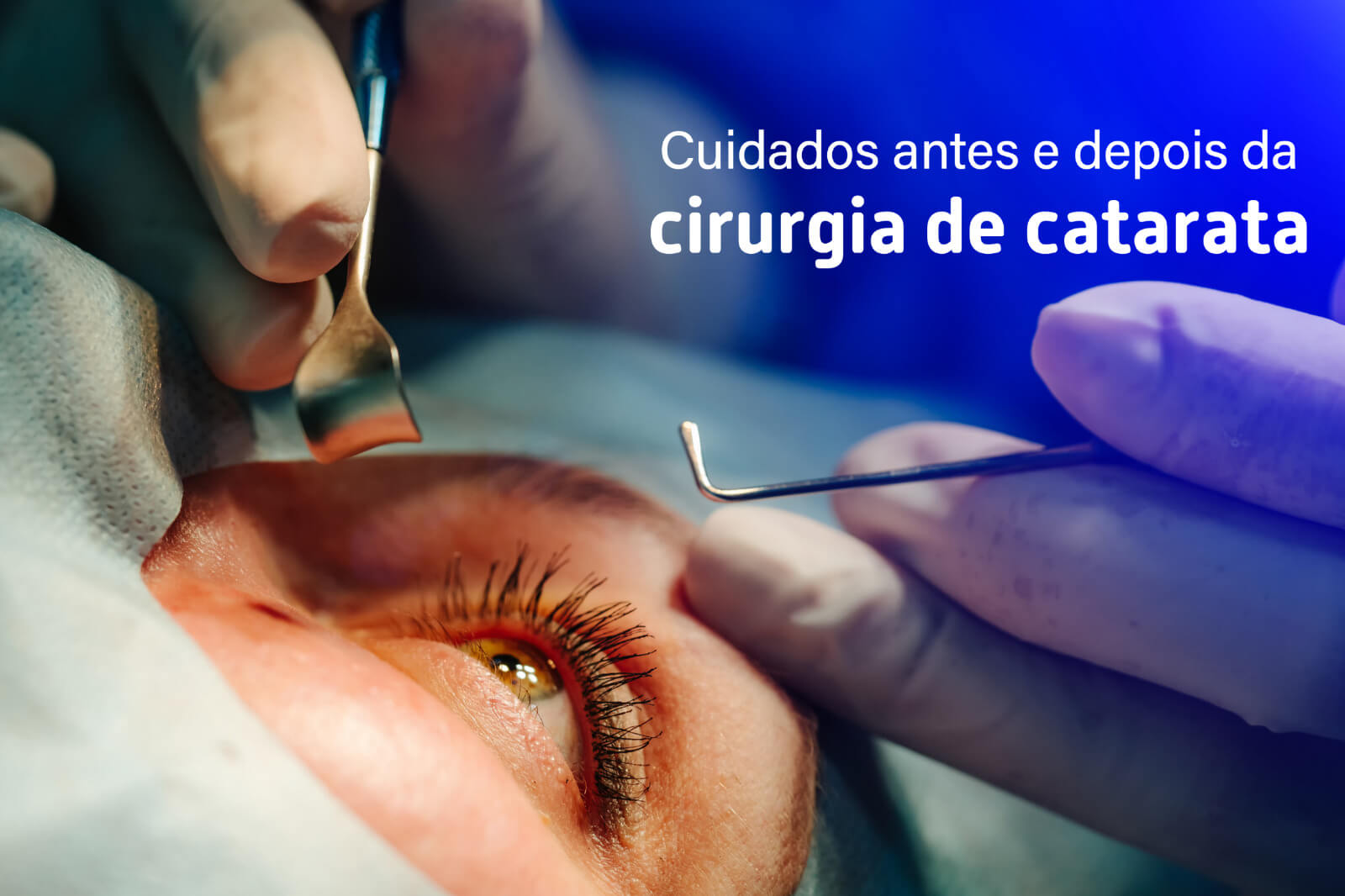 Cuidados antes e depois da cirurgia de catarata