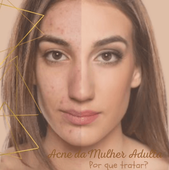 Acne da mulher adulta. Porque tratar? 