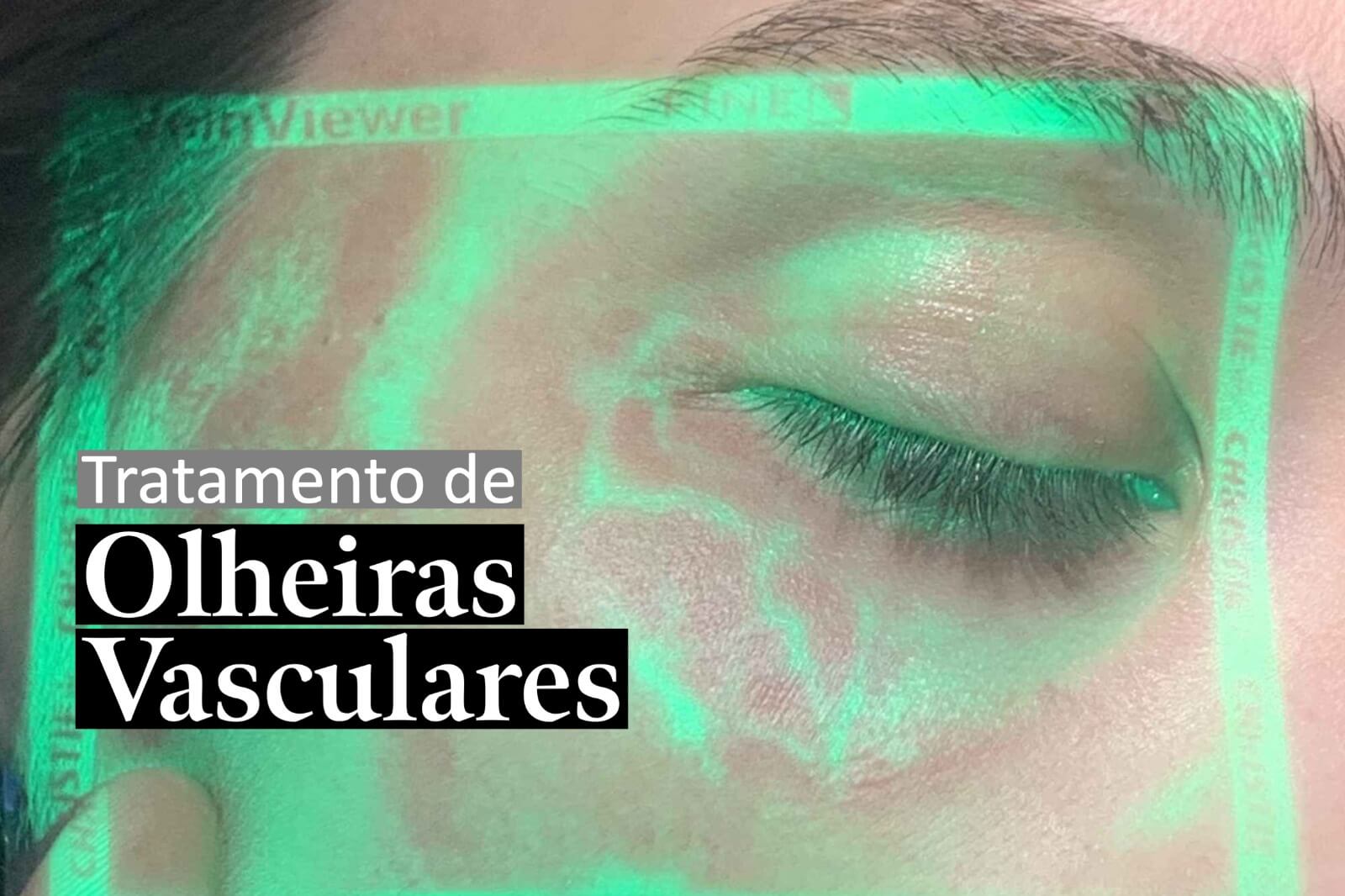 Tratamento De Olheiras Vasculares