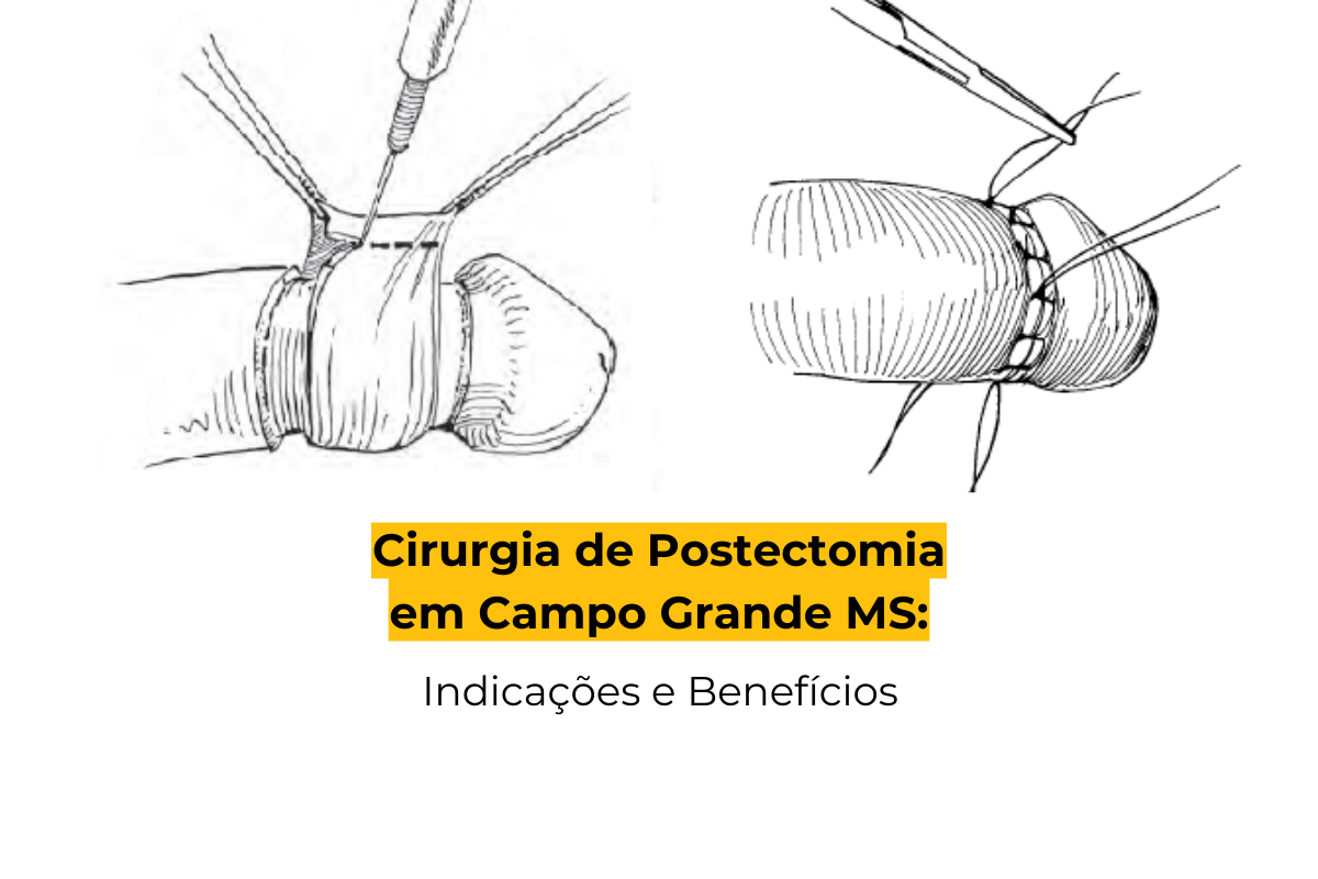 Cirurgia de Postectomia em Campo Grande MS: Indicações e Benefícios