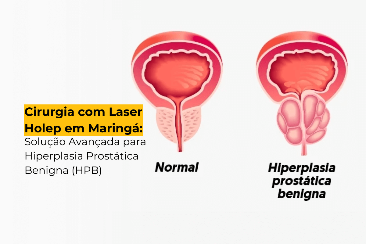 Cirurgia com Laser Holep em Maringá: Solução Avançada para Hiperplasia Prostática Benigna (HPB)