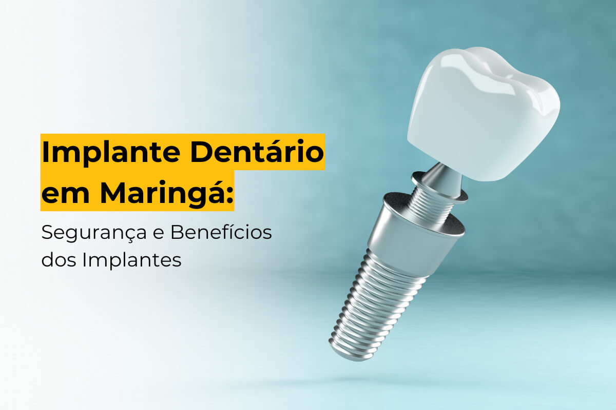 Implante Dentário em Maringá: Segurança e Benefícios dos Implantes