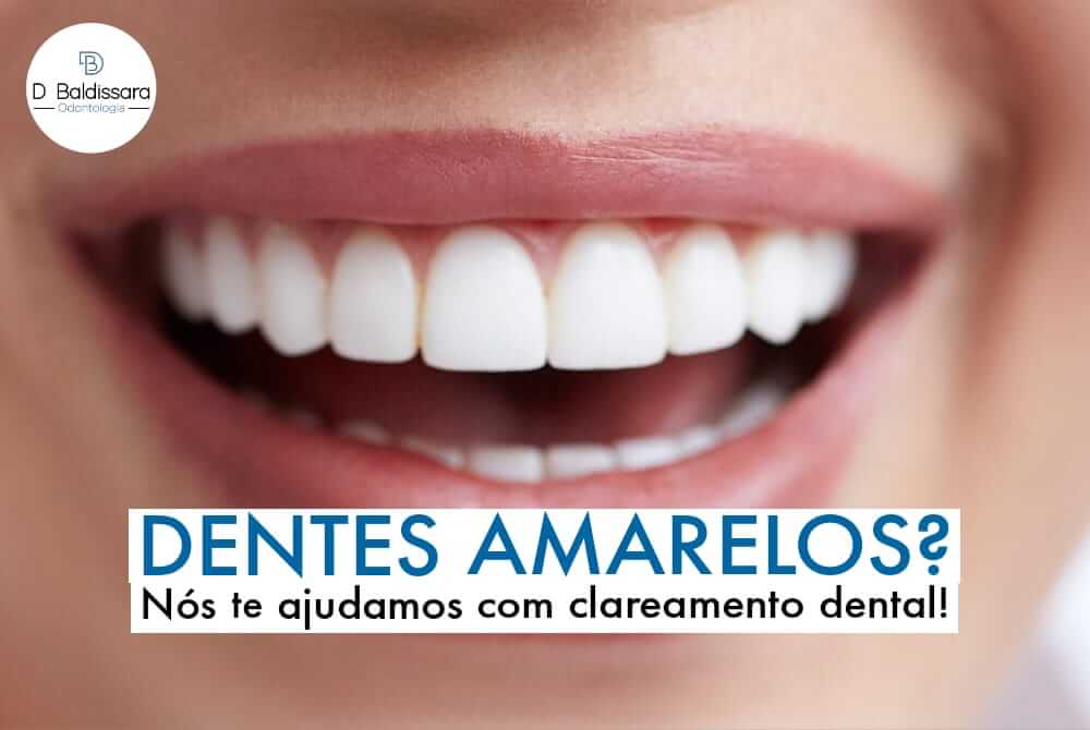 Dentes amarelos? Nós te ajudamos com clareamento dental!