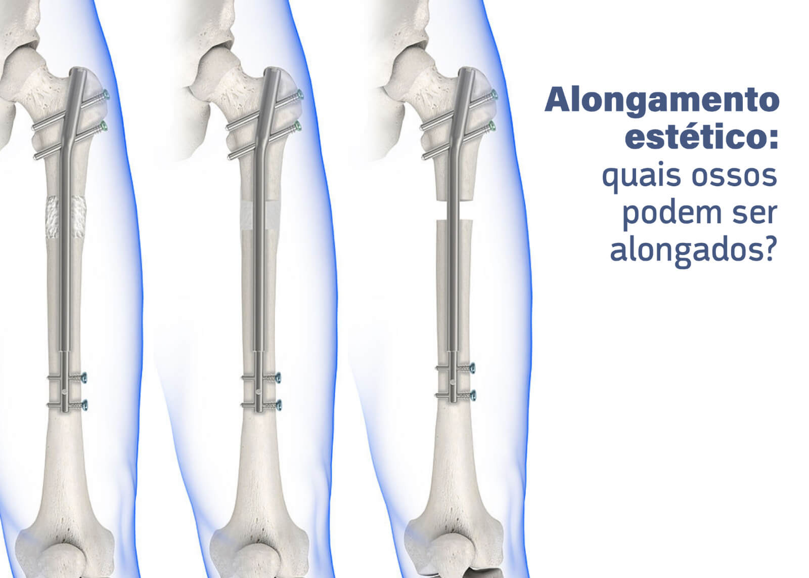 Alongamento estético: quais ossos podem ser alongados?