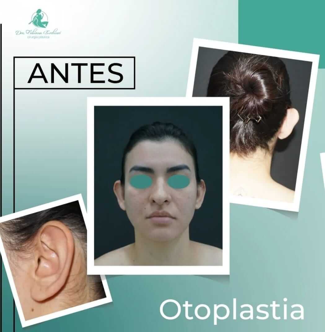 Otoplastia