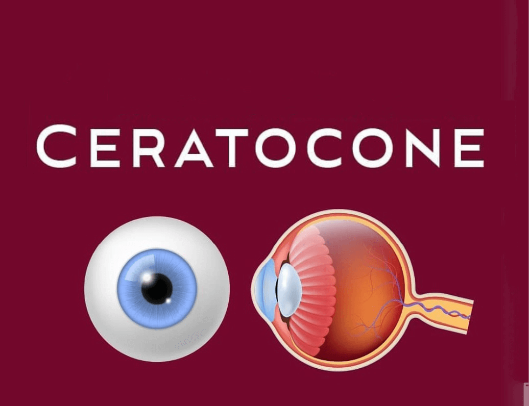 Ceratocone