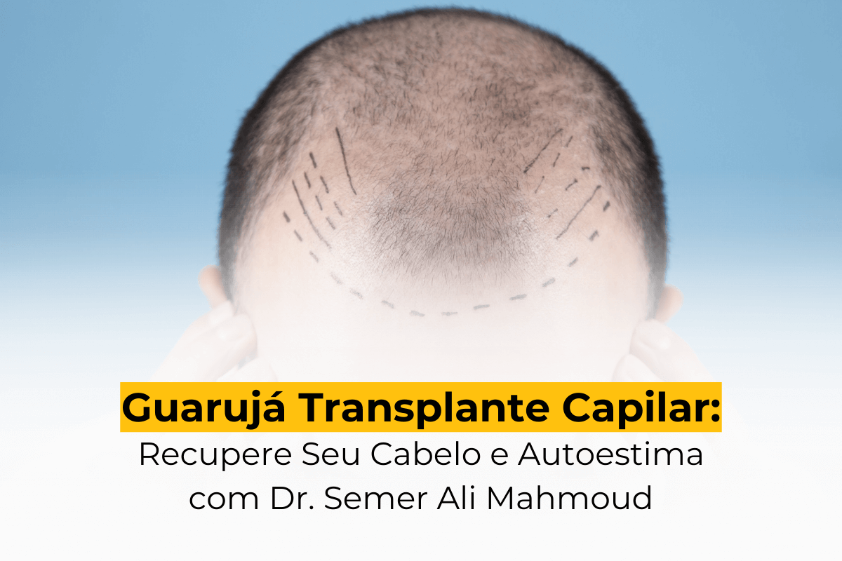 Guarujá Transplante Capilar: Recupere Seu Cabelo e Autoestima com Dr. Semer Ali Mahmoud