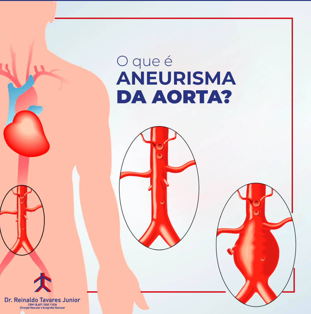 Aneurisma de Aorta