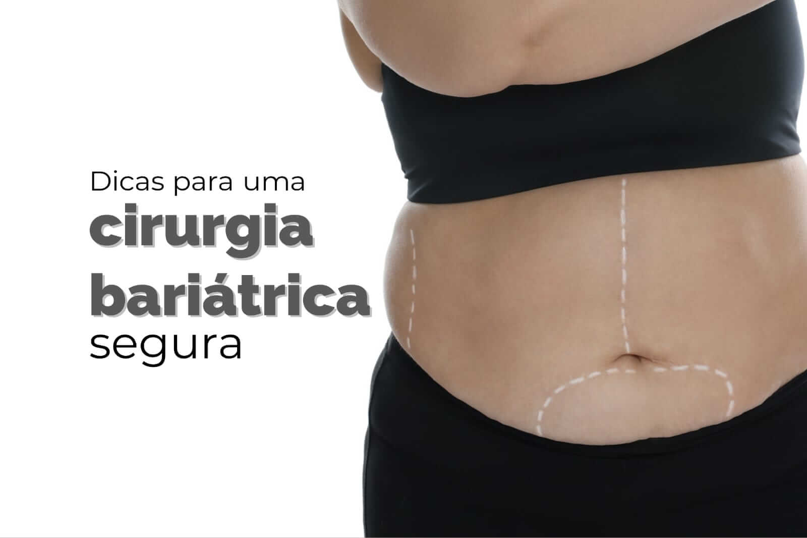 Dicas para uma Cirurgia Bariátrica Segura