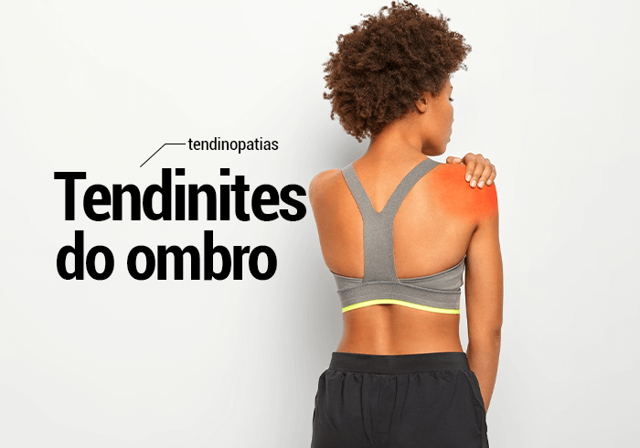 Tendinites (tendinopatias) do Ombro