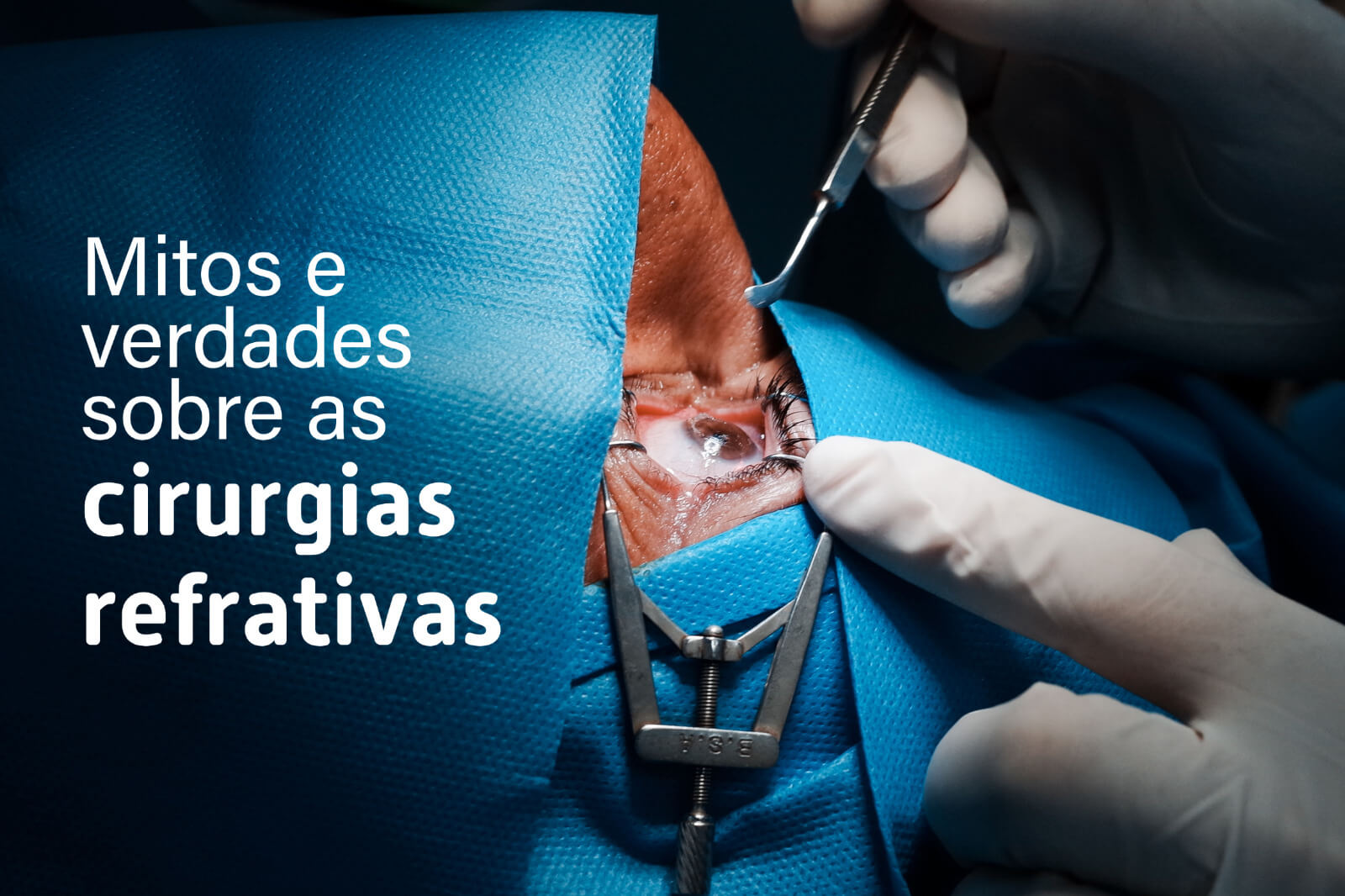 Mitos e verdades sobre as cirurgias refrativas