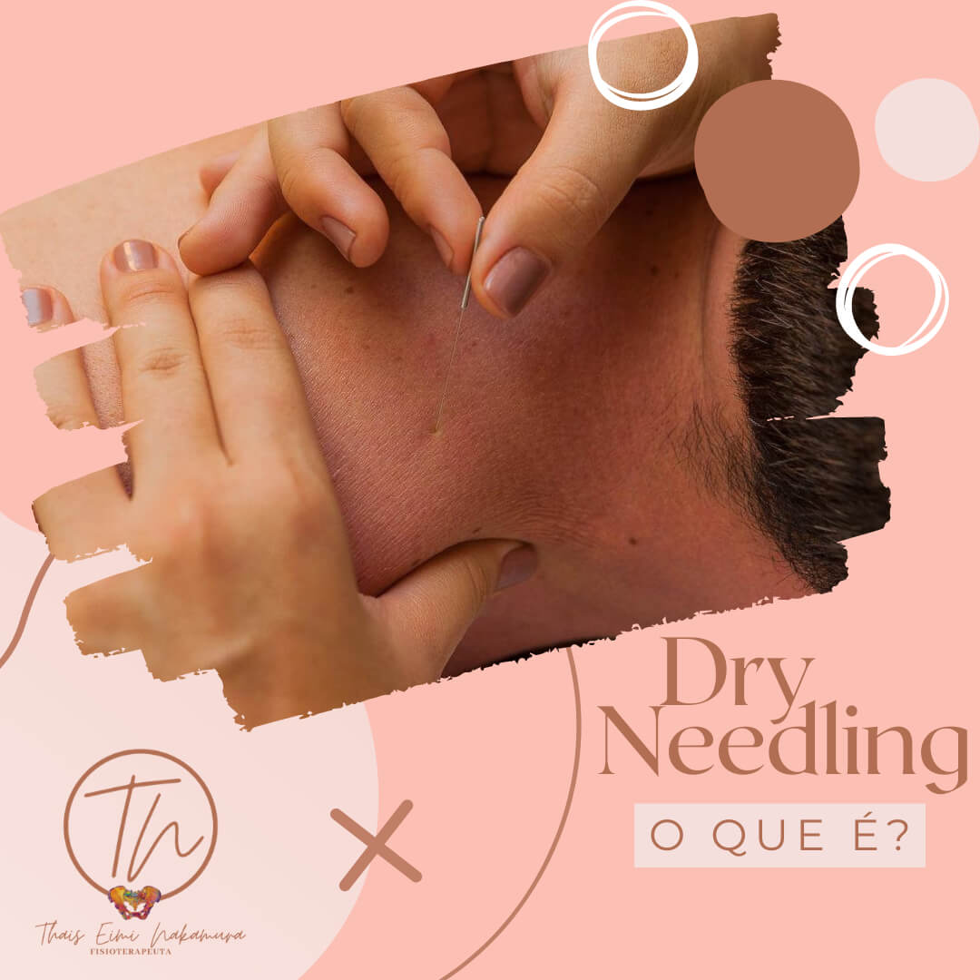 Dry needling, o que é?