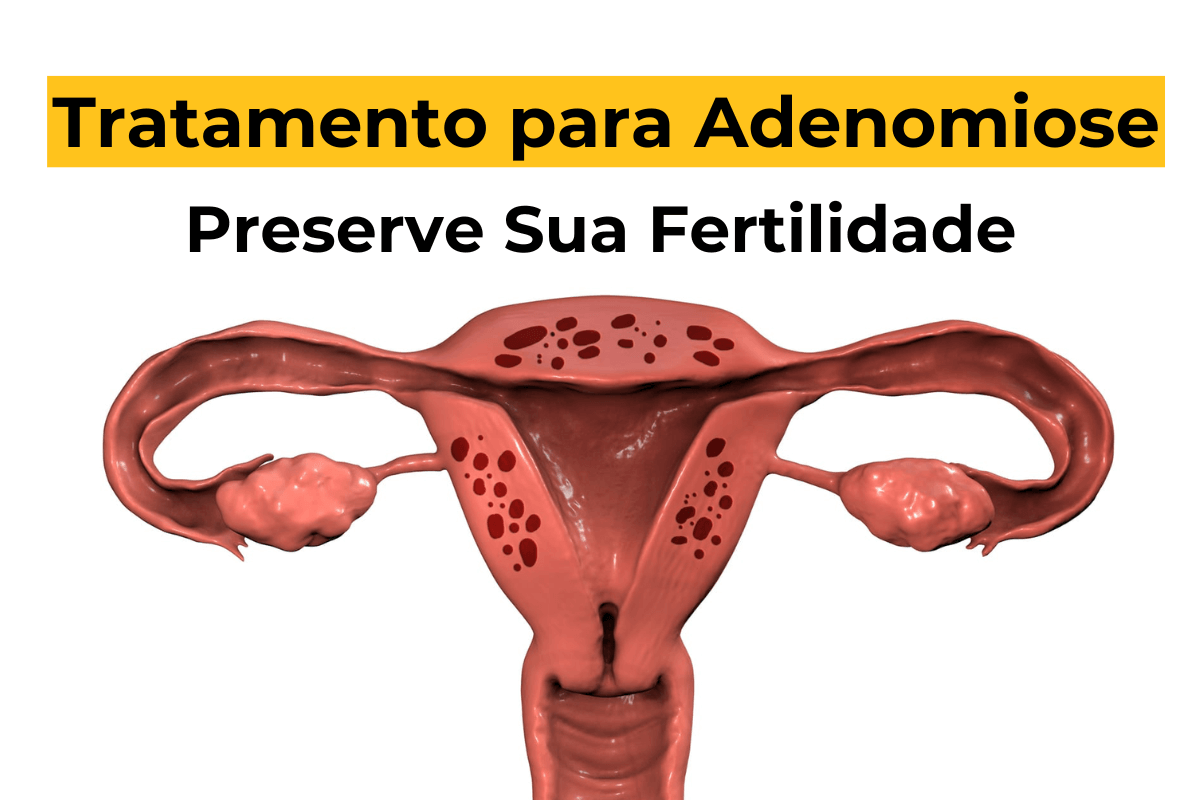 Tratamento para Adenomiose em Maringá: Preserve Sua Fertilidade
