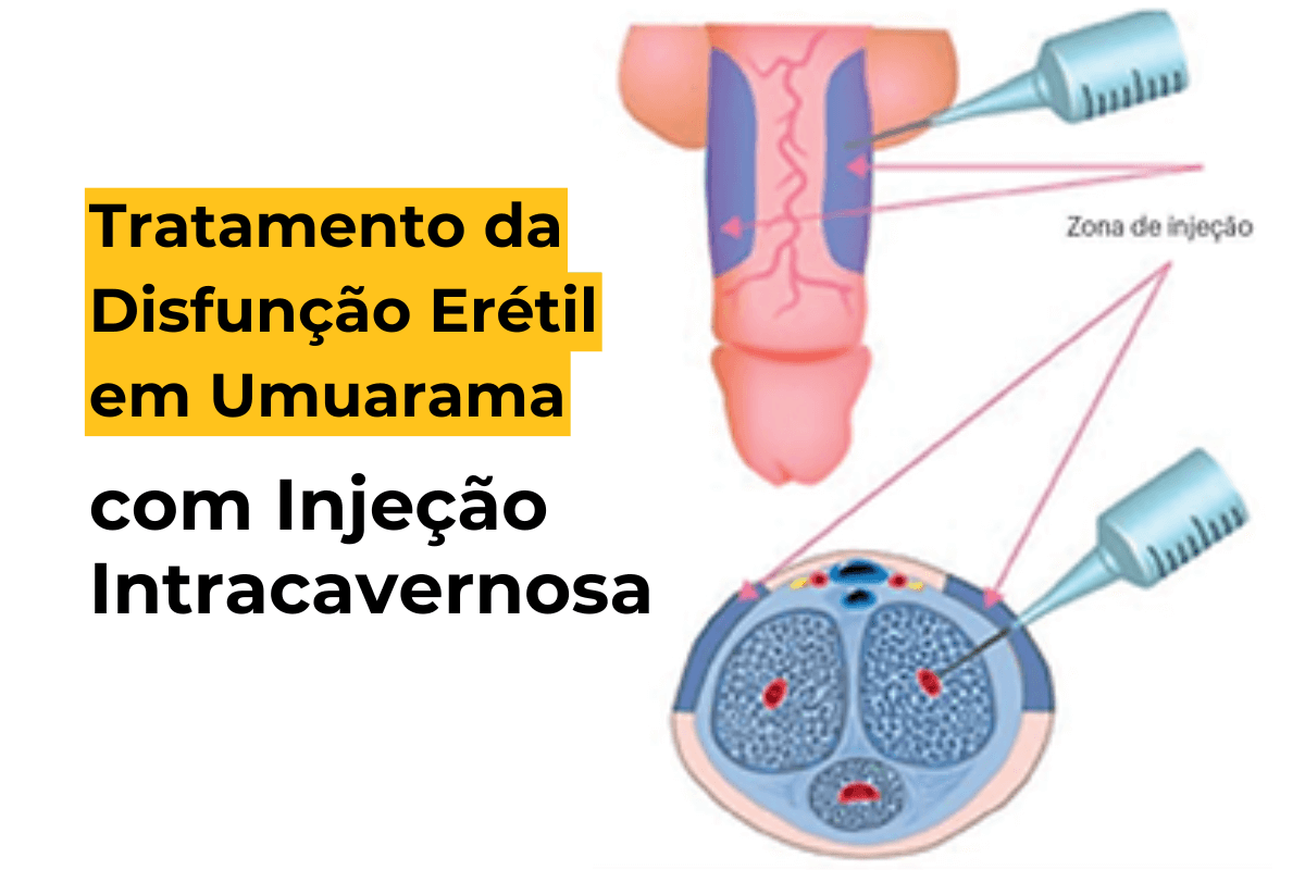 Tratamento da Disfunção Erétil em Umuarama com Injeção Intracavernosa