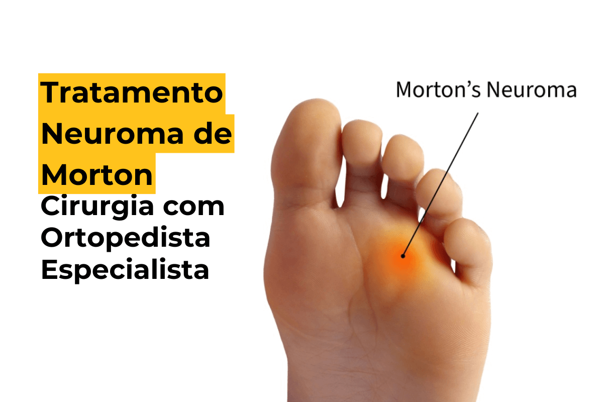 Tratamento Neuroma de Morton Curitiba: Cirurgia com Ortopedista Especialista