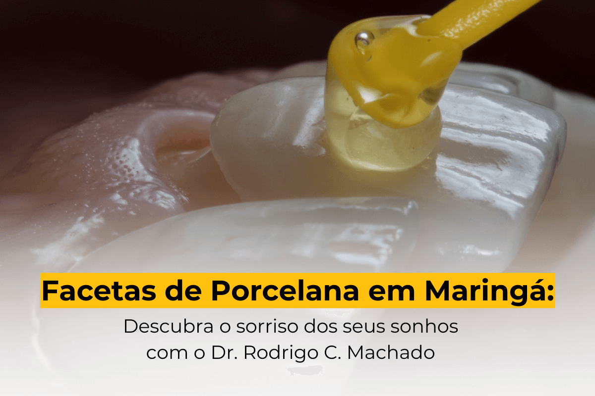 Facetas de Porcelana em Maringá: Descubra o sorriso dos seus sonhos com o Dr. Rodrigo C. Machado