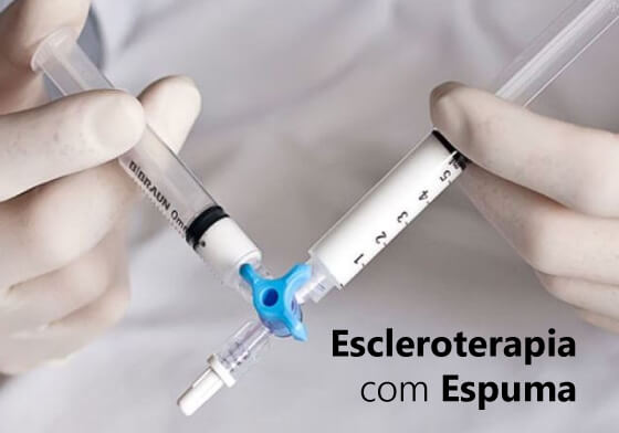 Escleroterapia com Espuma