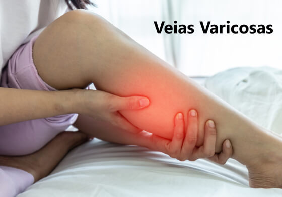 Veias Varicosas