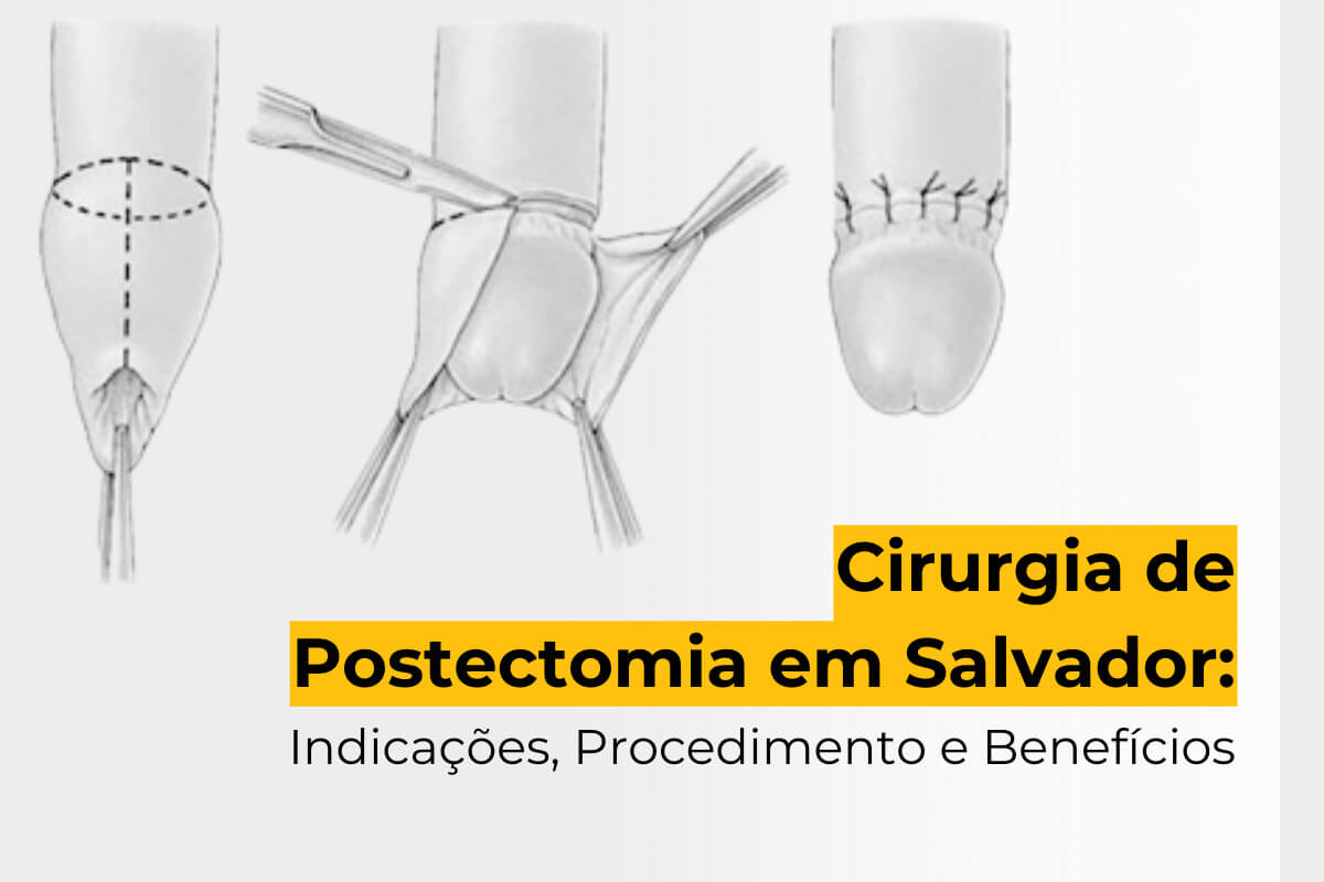 Cirurgia de Postectomia em Salvador: Indicações, Procedimento e Benefícios