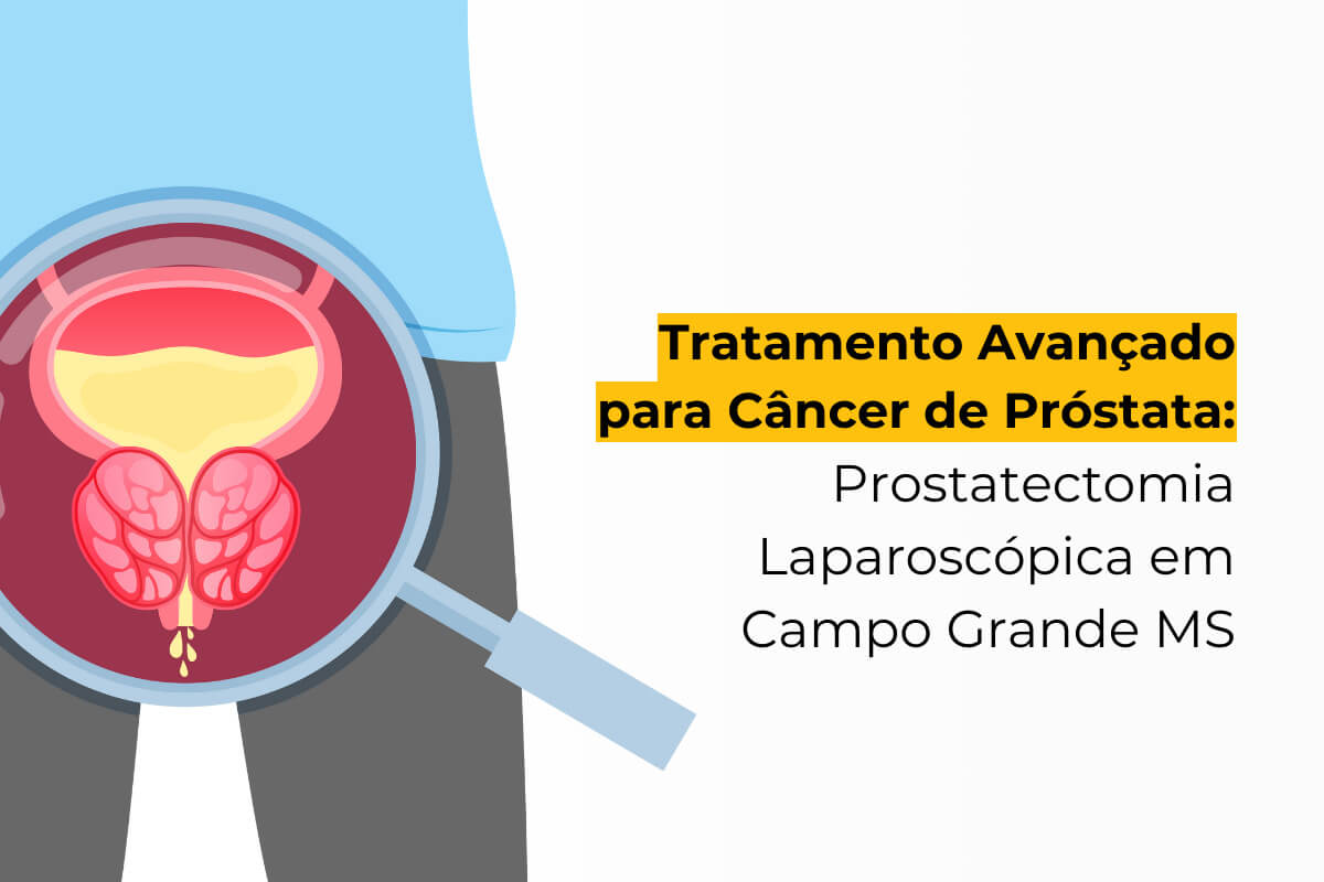 Tratamento Avançado para Câncer de Próstata: Prostatectomia Laparoscópica em Campo Grande MS