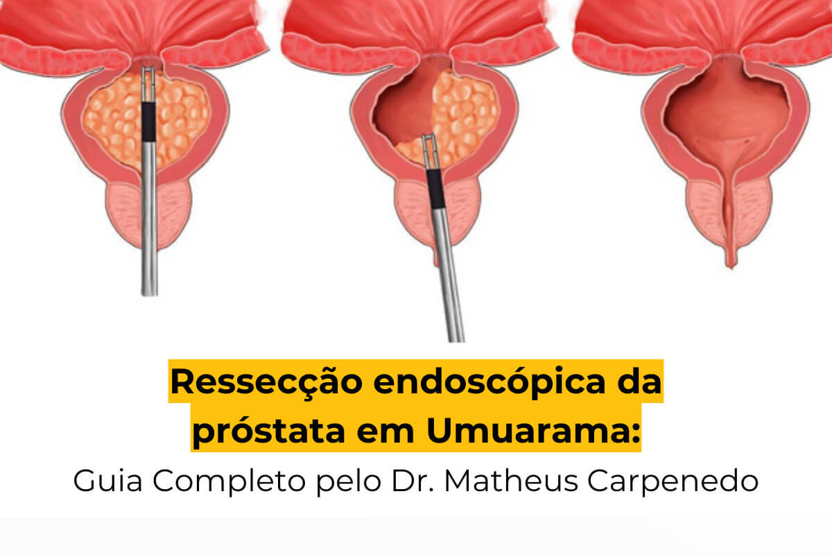 Ressecção Endoscópica da Próstata em Umuarama: Guia Completo pelo Dr. Matheus Carpenedo