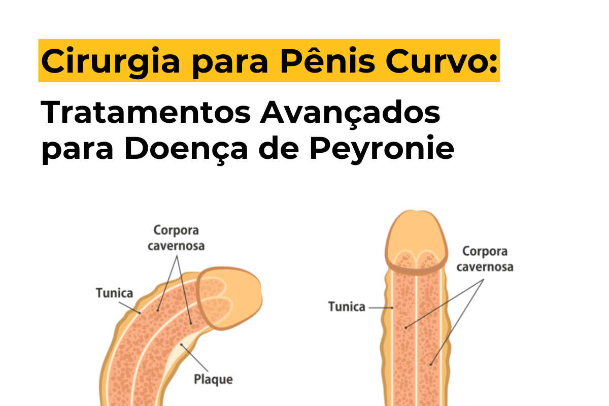 Cirurgia para Pênis Curvo em Curitiba: Tratamentos Avançados para Doença de Peyronie