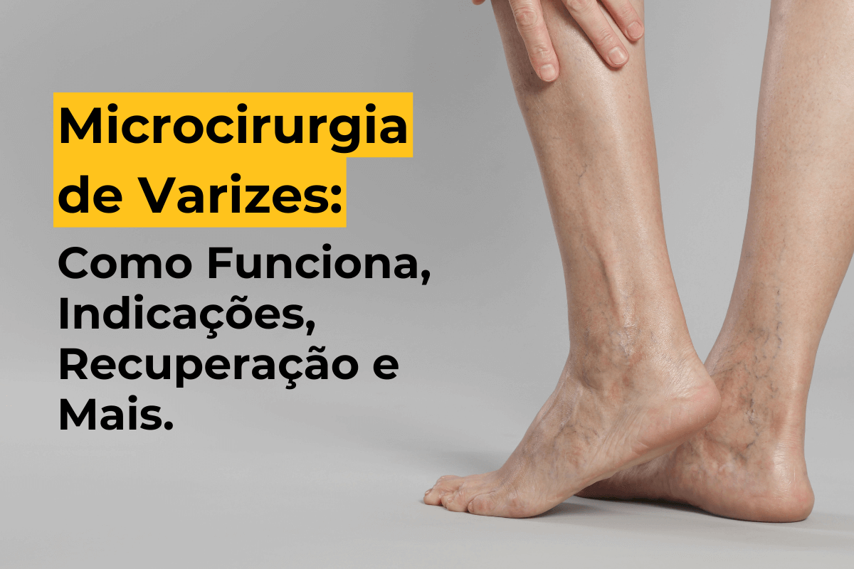 Microcirurgia de Varizes em Maringá: Como Funciona, Indicações, Recuperação e Mais.