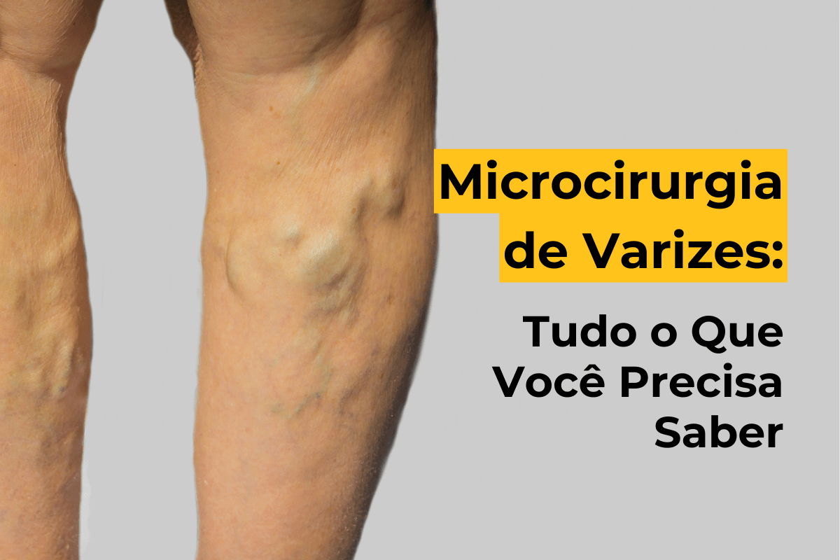 Microcirurgia de Varizes em Botafogo: Tudo o Que Você Precisa Saber