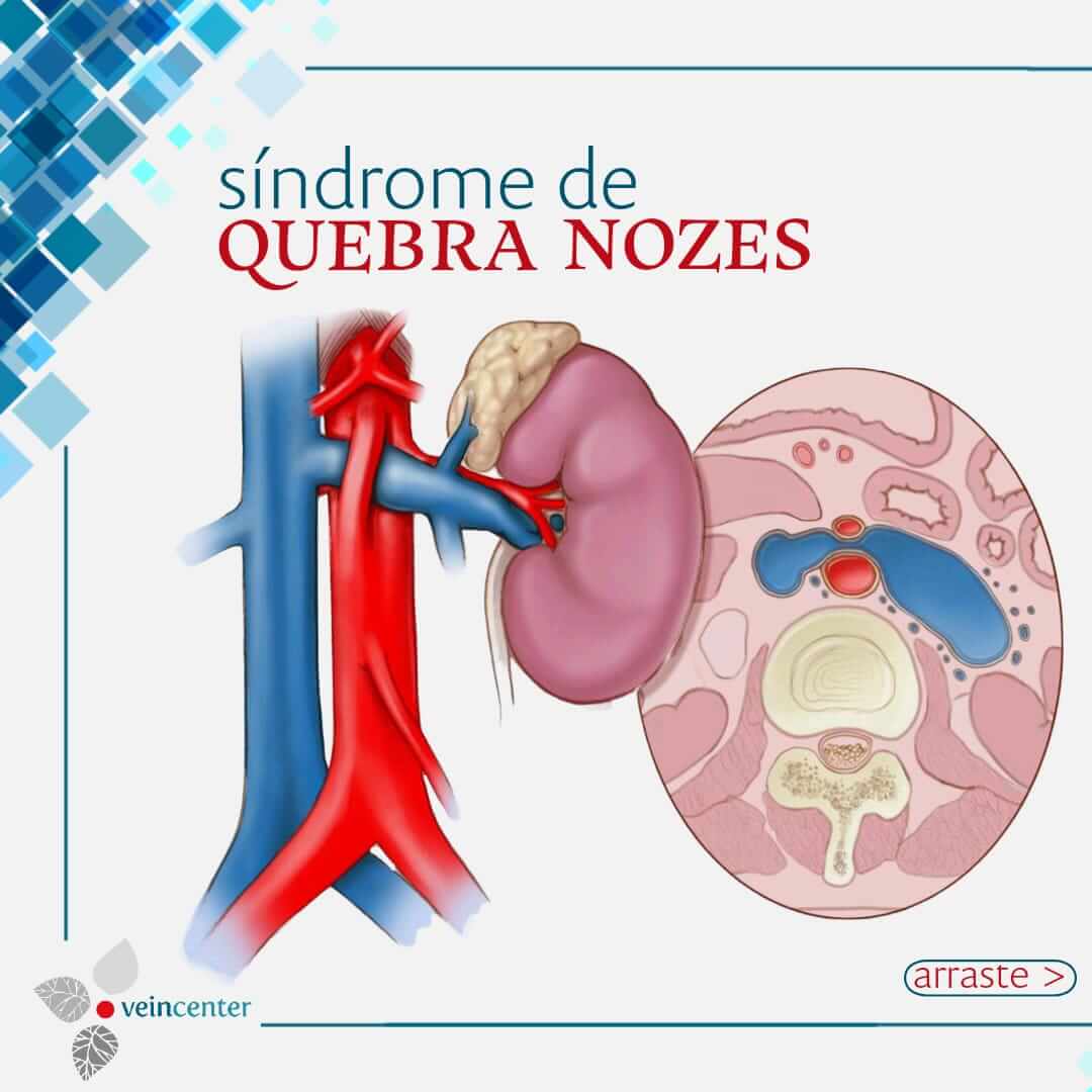 Síndrome de Quebra-Nozes