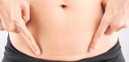 Pode fazer no mesmo dia uma histerectomia junto com abdominoplastia?