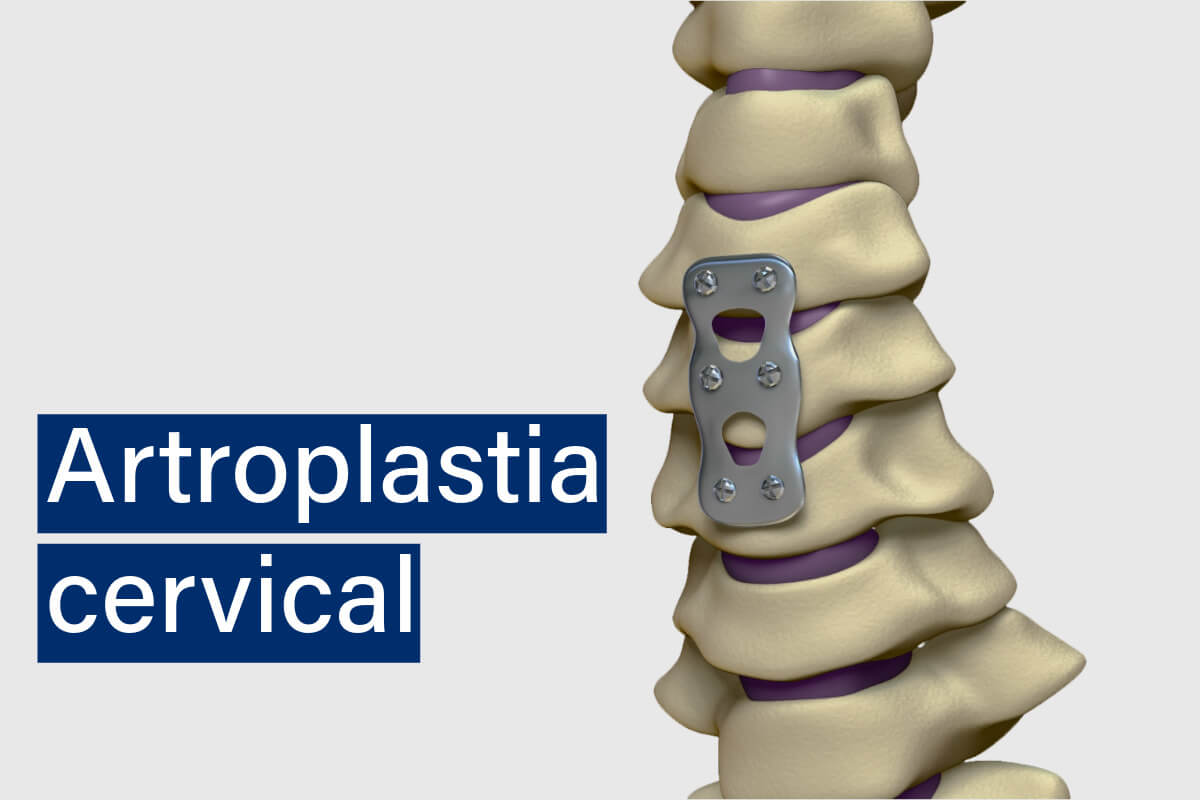 Artroplastia cervical