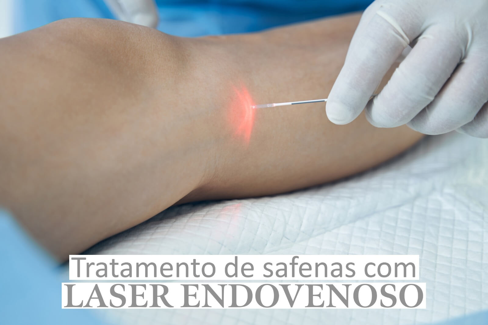 Tratamento de safenas com laser endovenoso