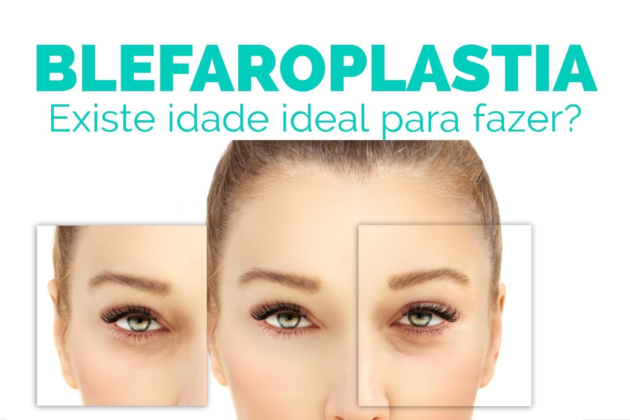 Blefaroplastia: Existe idade ideal para fazer?