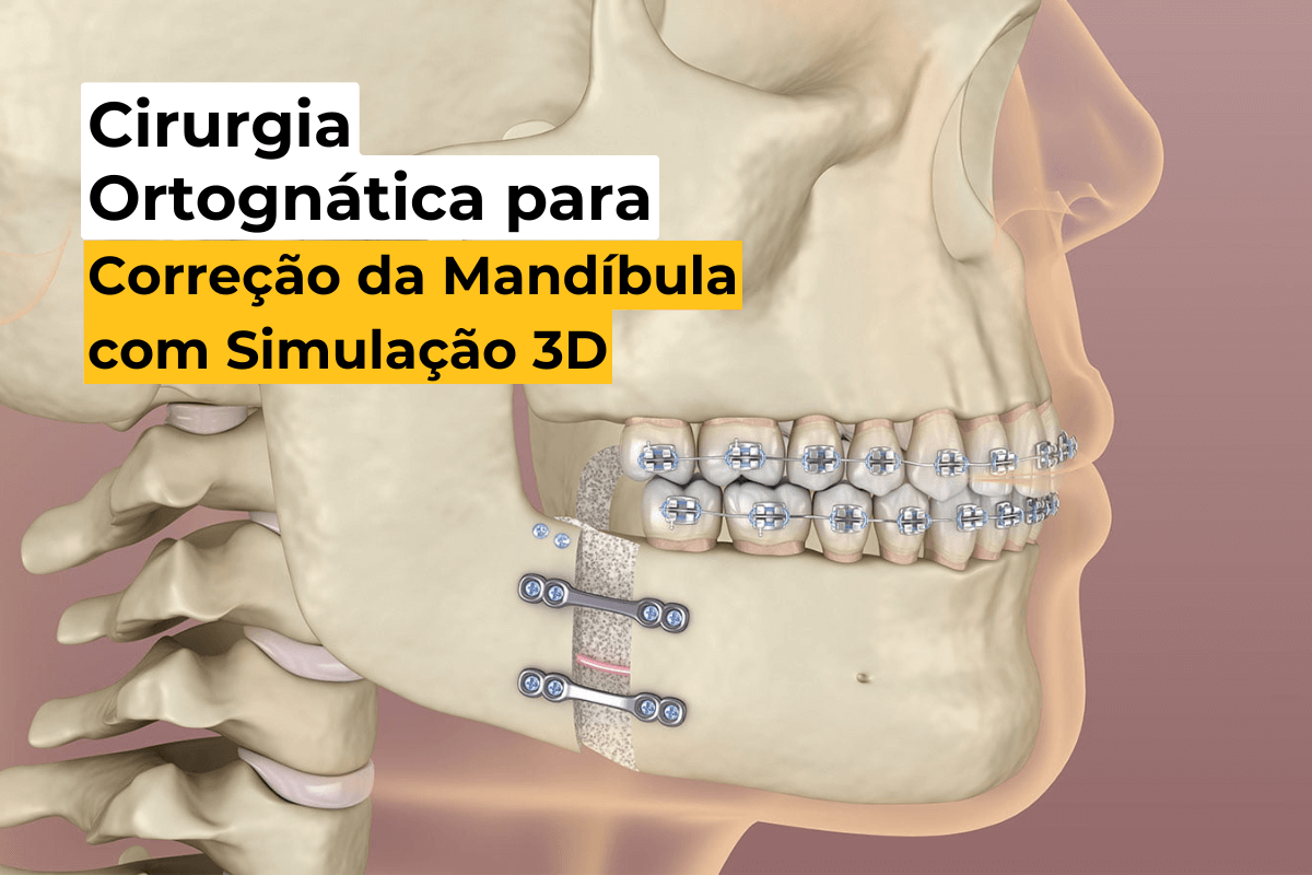 Cirurgia Ortognática para Correção da Mandíbula em Maringá com Simulação 3D