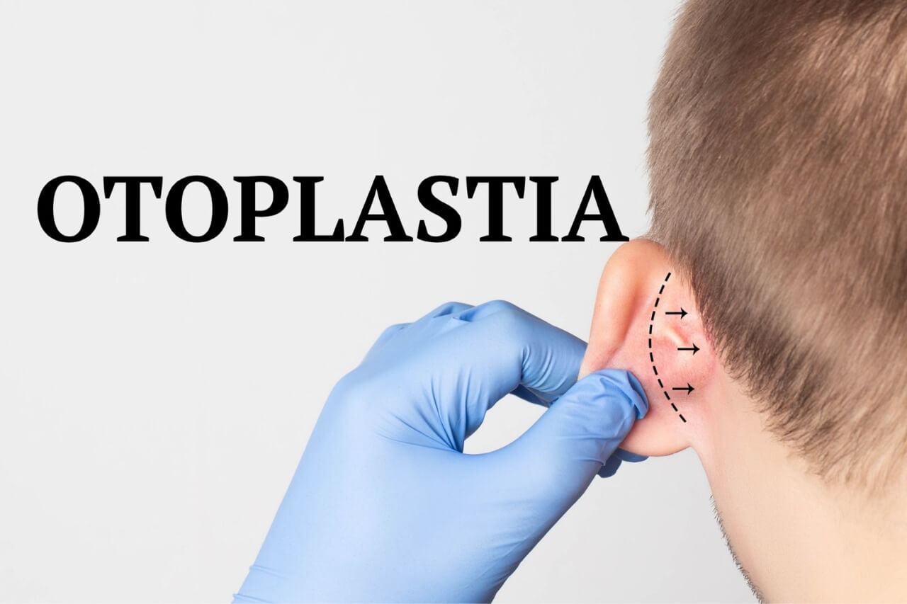 Otoplastia