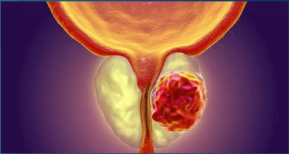 Câncer de Próstata - fatores de risco e prevenção